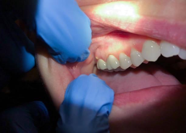 Best Broken Tooth Emergency  in Asbury Lake, FL